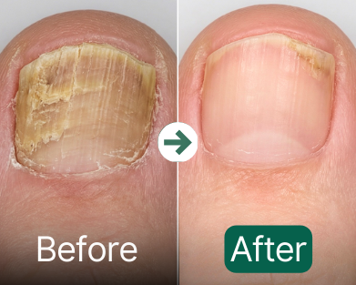 Before and after comparison of a nail with yellowish discoloration.